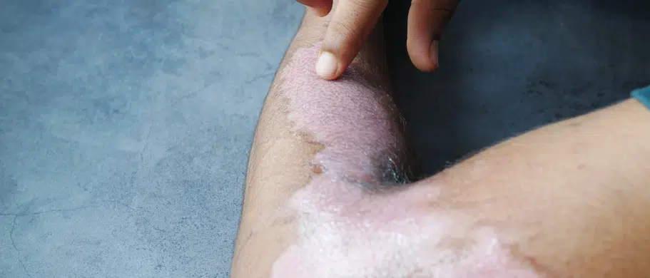 The image depicts skin discoloration on a hand